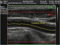 Carotid CAD