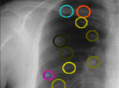 Lung CAD 