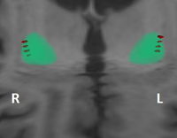 DBS - Deep Brain Stimulation 