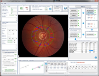 Retina CAD